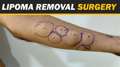 Multiple Lipoma Removal From Hand Youtube