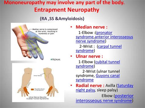 Ppt Neuropathy In Rheumatic Diseases By Dr Hegazy Mogahed Powerpoint