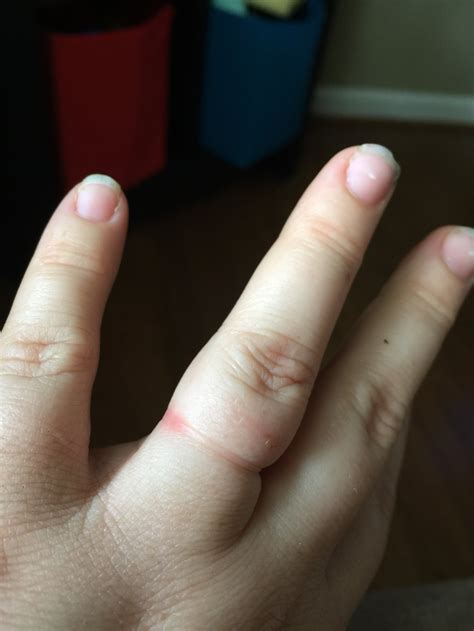 Swollen Fingers — The Bump