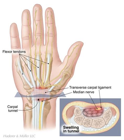 Patient Education Article Colorado Springs Orthopaedic Group Pe