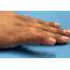 Mallet Finger – Hand Therapy Group