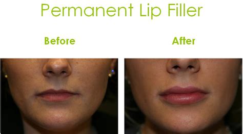 Permanent Lip Filler