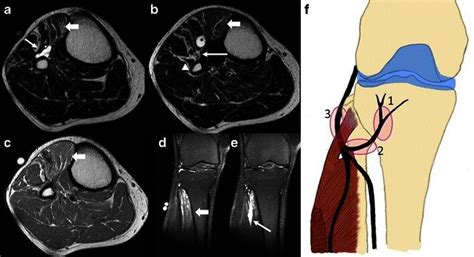 Recurrent Intraneural Ganglion Axial T2 Wi At The Level Of The Right