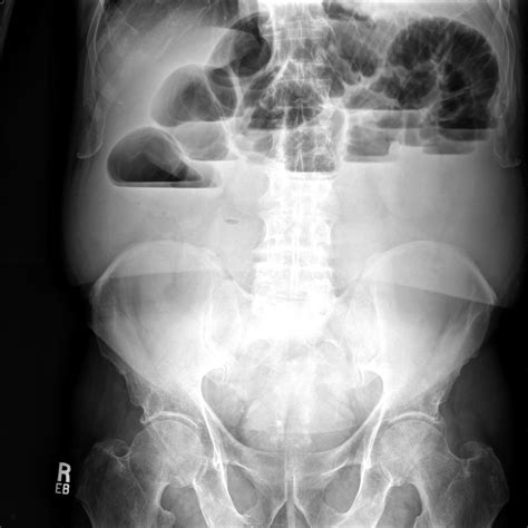 Small Bowel Obstruction 3788 Sbo Upright Surgery Photos