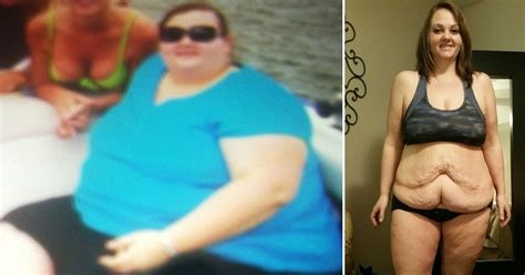 Woman Spends K Having More Than Half A Stone Of Excess Skin Removed