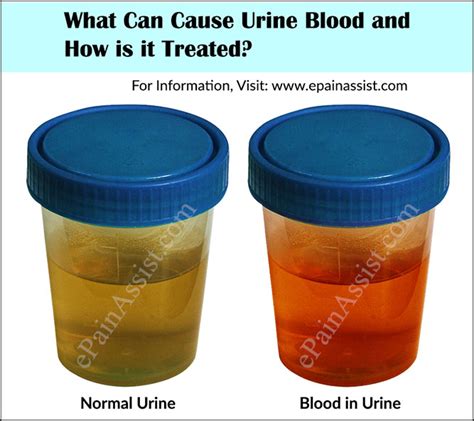 What Can Cause Urine Blood And How Is It Treated