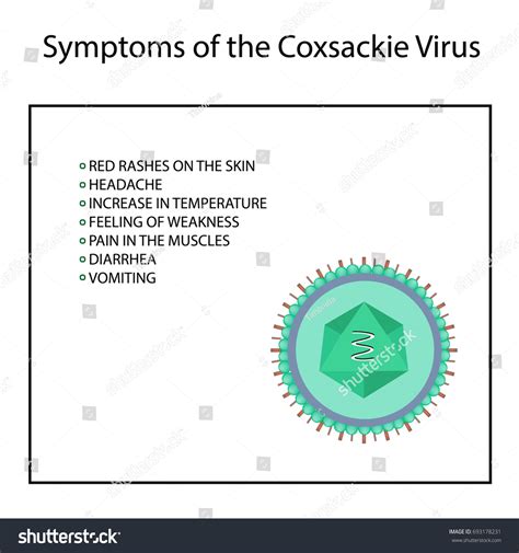 Symptoms Infection Coxsackie Virus Enterovirus Infographics Stock Vector Royalty Free