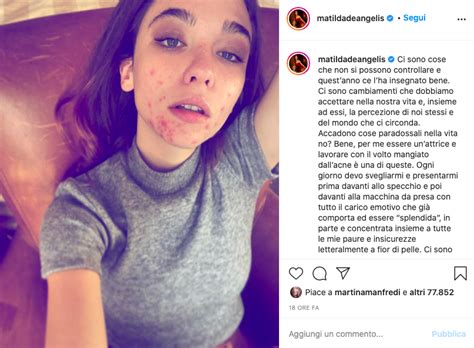 Star Senza Trucco Matilda De Angelis Mostra L’acne Sul Viso Light Words