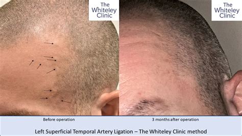 Removal Bulging Superficial Temporal Arteries The Whiteley Clinic