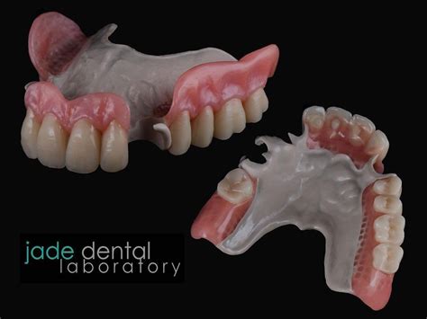 Partial Flexible Dentures Peek Dentures Metal Free Dentures — All