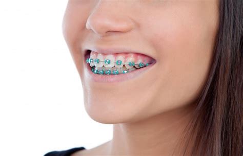 Swollen Gums With Braces Causes Treatments And Prevention Koch Orthodontics