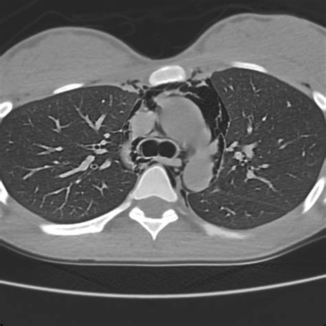 Pdf Spontaneous Pneumomediastinum In A Healthy Young Female A Case