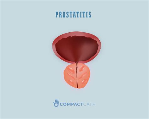 Four Types Of Prostatitis Causes Symptoms And Treatments Compactcath