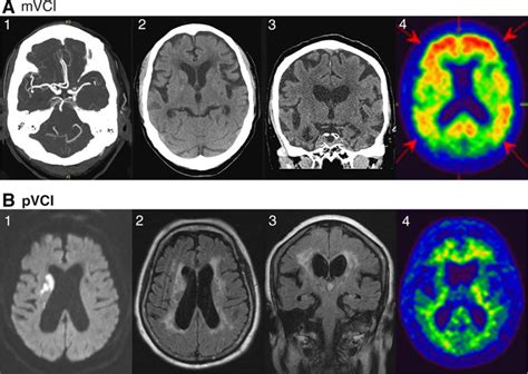 Influence Of Amyloid β On Cognitive Decline After Stroketransient