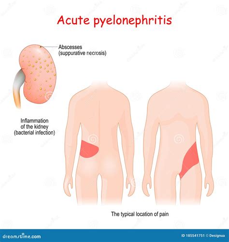 Acute Pyelonephritis Inflammation Of The Kidney Stock Vector Illustration Of Anatomical