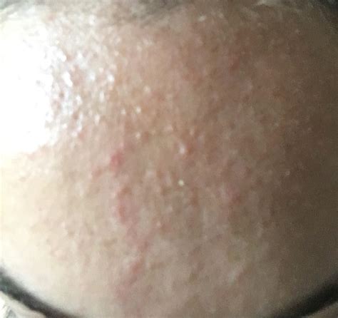 Routine Help For Little Red Bumps On Forehead
