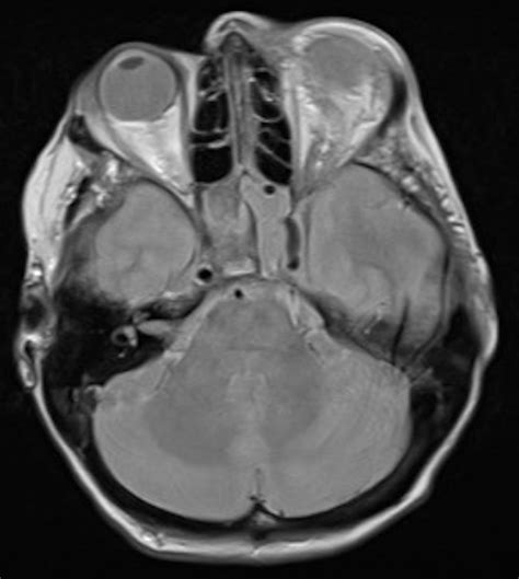 Sphenoid Sinusitis A Rare Cause Of Ischaemic Stroke Bmj Case Reports
