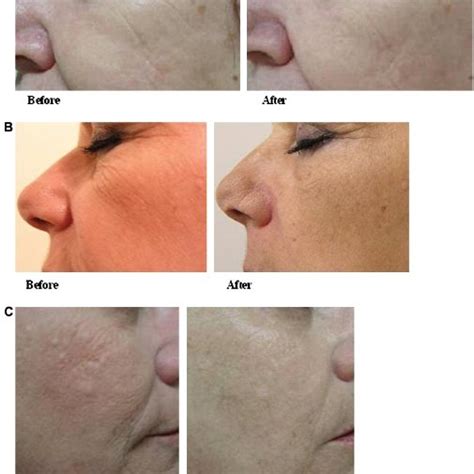 Treatment Of Facial Rhytids A Facial Rhytids Before And 1 Month