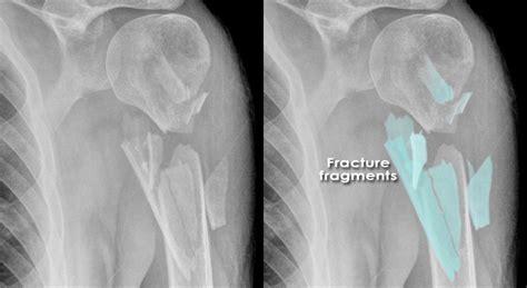 Introduction To Trauma X Ray Comminuted Fractures