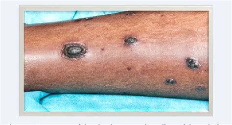 Figure 1 From Psoriasis And Hiv Rupioid Psoriasis An Uncommon
