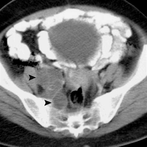 A Contrast Enhanced Ct Scan Of The Pelvis In The Axial Plane Showing