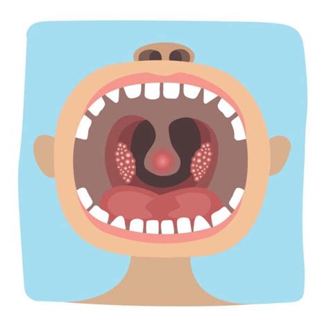 10 Diphtheria Throat Illustrations Royalty Free Vector Graphics