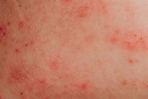 Allergies And Skin Conditions