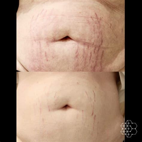 Let S Talk About Laser Stretch Mark Removal Treatment Skin Technique