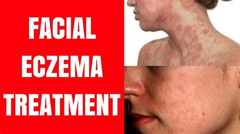 Facial For Eczema Nude Images