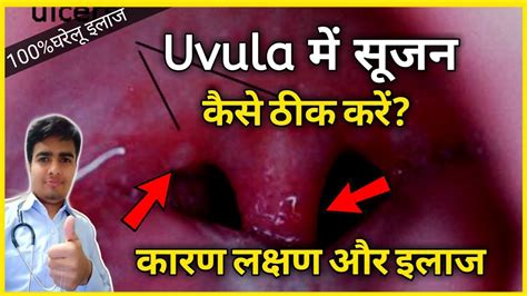 Uvula में सूजन का इलाज गले में इन्फेक्शन इलाज Uvula Ka Ilaj In