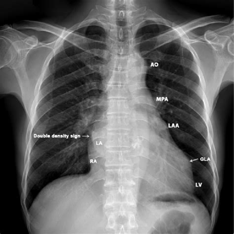 X Ray Chest Pa Postero Anterior View Showing The Bump Left Heart My XXX Hot Girl