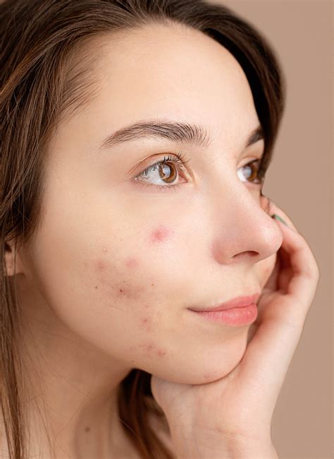 Acne Spot Treatments That Actually Work