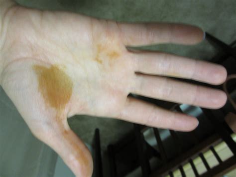 Orange Brown Spots On Hands The Summer Is Coming So It Makes The