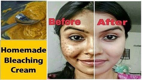 Homemade Bleaching Cream For Skin Lightening And Pigmentation Dark