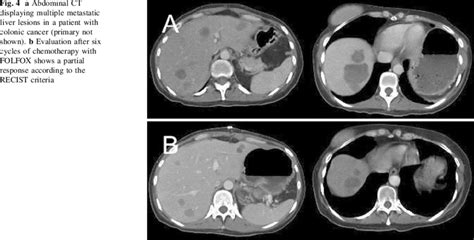A Abdominal Ct Displaying Multiple Metastatic Liver Lesions In A