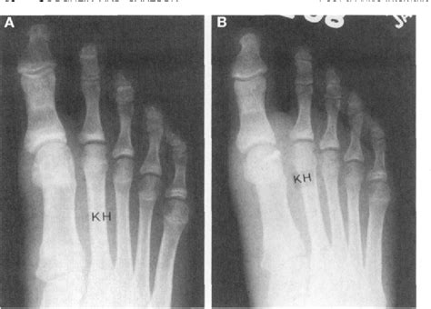 Figure 4 From Treatment Of Hallux Valgus With An Increased Distal