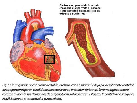 Qué es la angina de pecho estable o angina crónica estable CardiosaudeFerrol