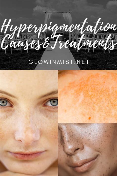 Hyperpigmentation Causes Home Remedies And Medical Treatments Justinboey