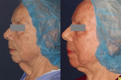 Facial Liposculpture San Diego Ca Cosmetic Laser Dermatology