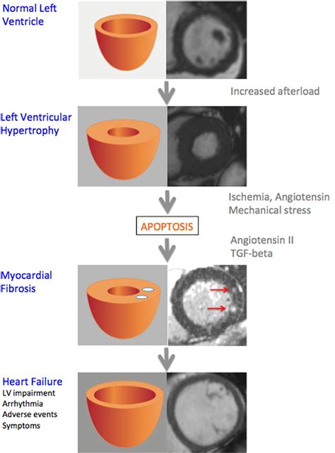 Calcific Aortic Stenosis A Disease Of The Valve And The Myocardium