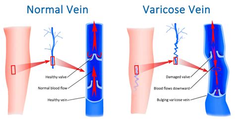 Varicose Veins Overview Symptoms And Diagnosis Vascular Surgeon