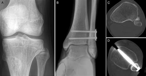 Maisonneuve Equivalent Injury With Proximal Tibiofibular Joint