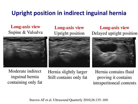Ultrasound Of Groin And Anterior Abdominal Wall Hernias