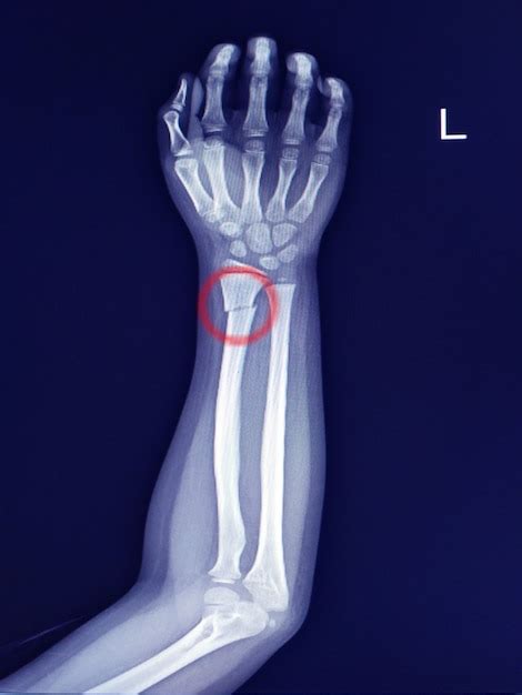 Premium Photo X Ray Forearm Finding Fracture Distal Shaft Of Radius