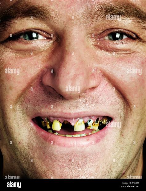 Rotten Teeth Fotos Und Bildmaterial In Hoher Auflösung Alamy