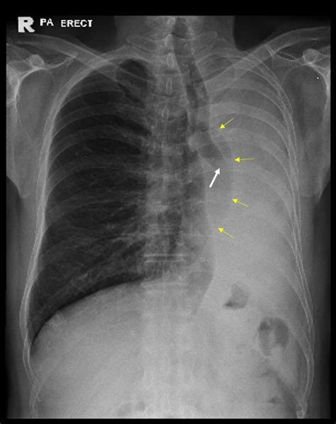 Opaque Hemithorax With Ipsilateral Mediastinal Shift Radiology Cases