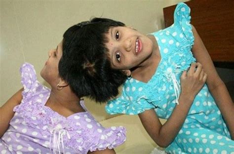 conjoined twins can t be separated minister