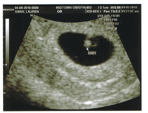 Baby Swanpenter 6 Week Ultrasound