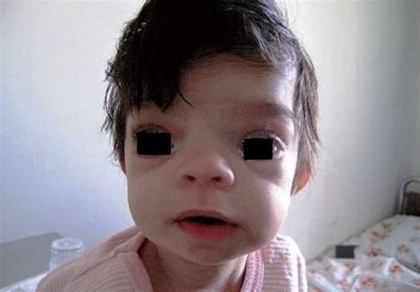 Apert Syndrome Pictures Causes Symptoms Treatment Prognosis