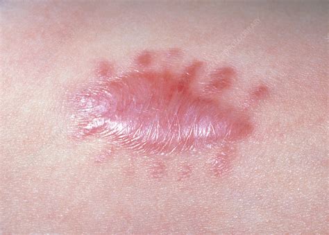 Close Up Of A Keloid Scar Developed After Surgery Stock Image M3320006 Science Photo Library